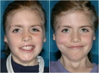 Facial Paralysis