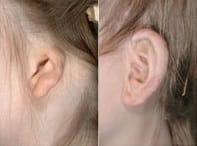 Microtia