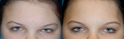Fibrous Dysplasia - Reduction and Reshaping of Forehead