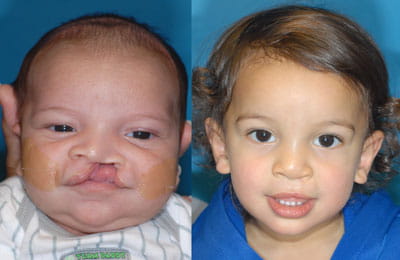 Unilateral Cleft Lip