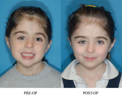 Unicoronal Synostosis (left image pre-op; right image post-op)