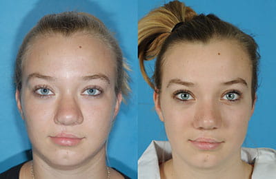 2nd stage Cleft Rhinoplasty Revision (left image pre-op; right image post-op)