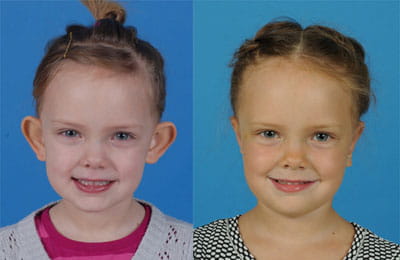 Bilateral Otoplasty (full face view; left image pre-op; right image post-op)