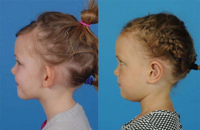 Bilateral Otoplasty (left cheek view full view; left image pre-op; right image post-op)