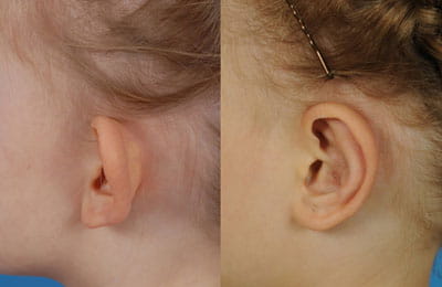 Bilateral Otoplasty (left cheek close-up view; left image pre-op; right image post-op)