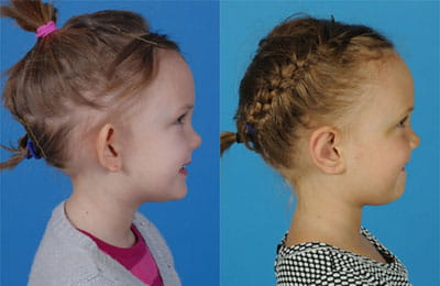 Bilateral Otoplasty (right cheek full view; left image pre-op; right image post-op)