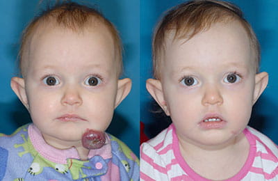 Removal of Hemangioma