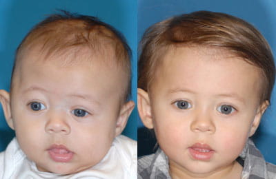 Cranial Vault Remodeling w Frontal Orbital Advancement & Lateral Canthoplasty (full face view; left image pre-op; right image post-op)
