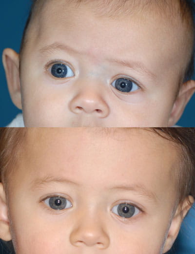 Cranial Vault Remodeling w Frontal Orbital Advancement & Lateral Canthoplasty (close-up view; top image pre-op; bottom image post-op)