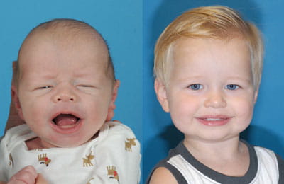 Craniosynostosis (full face view; left image younger and pre-op; right image older and post-op)