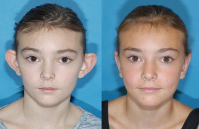 Bilateral Otoplasty (full face front view; left image pre-op; right image post-op)