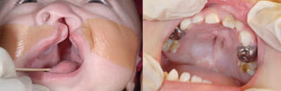 Cleft Palate Repair (left image pre-op; right image post-op)