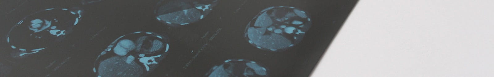 Mammography results on screen.