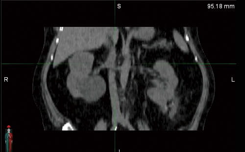 CT scan