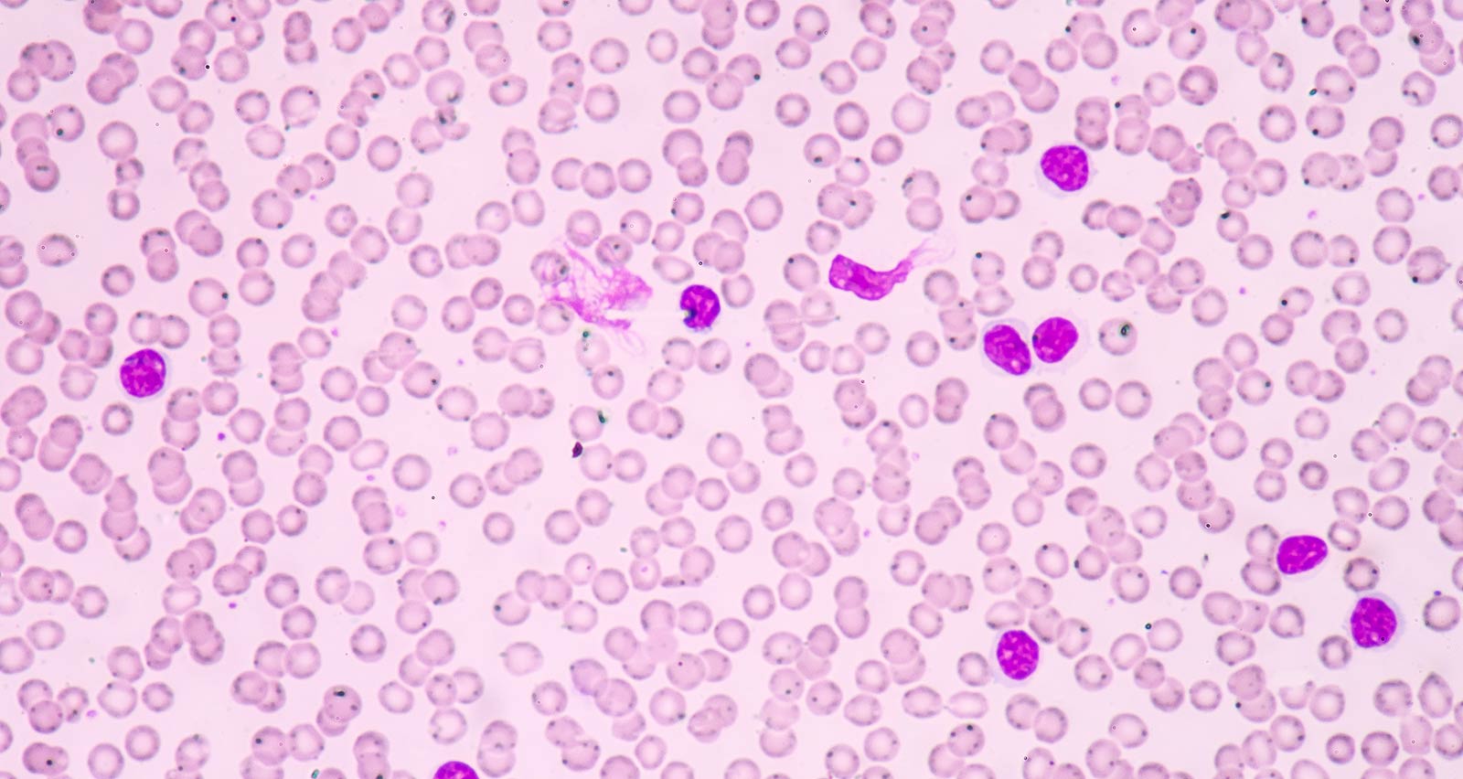 Microscopic view of Chronic Lymphocytic Leukemia
