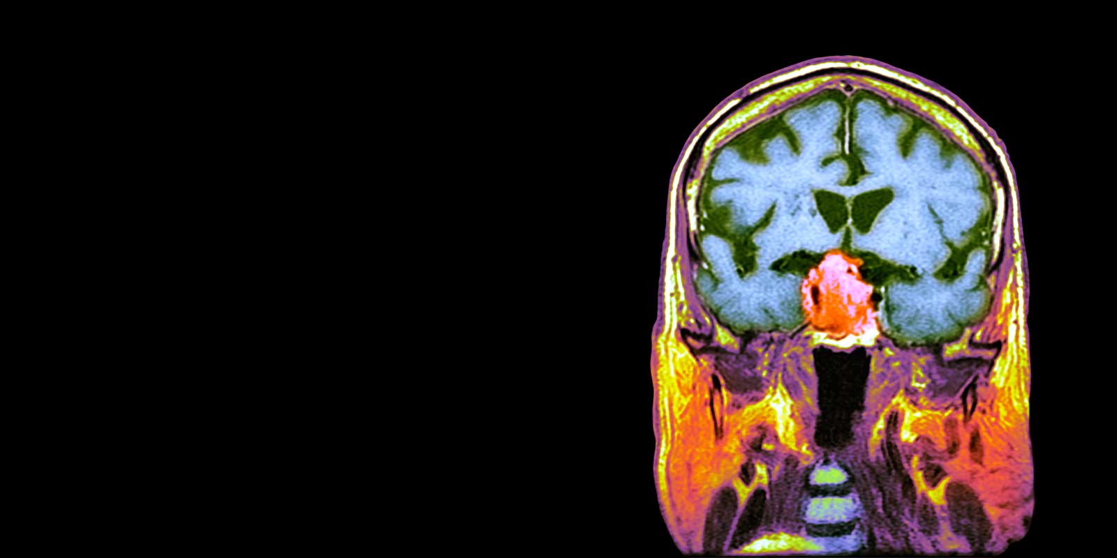 CT scan of a Pituitary tumor