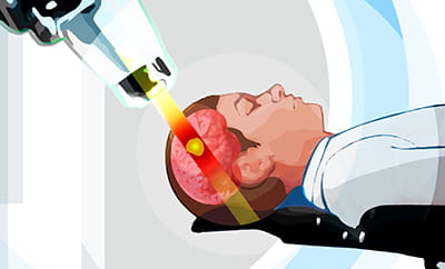 UH Seidman Cancer Center - Services - Proton Therapy - machine with beam into brain