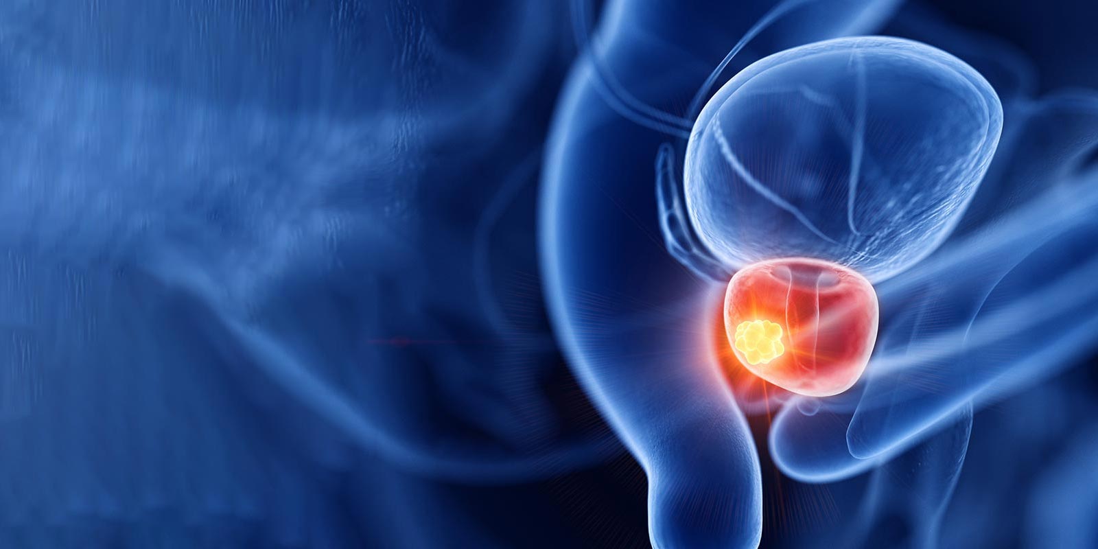 Illustration of Prostate Cancer
