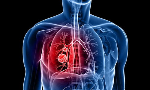 Illustration of Lung Cancer