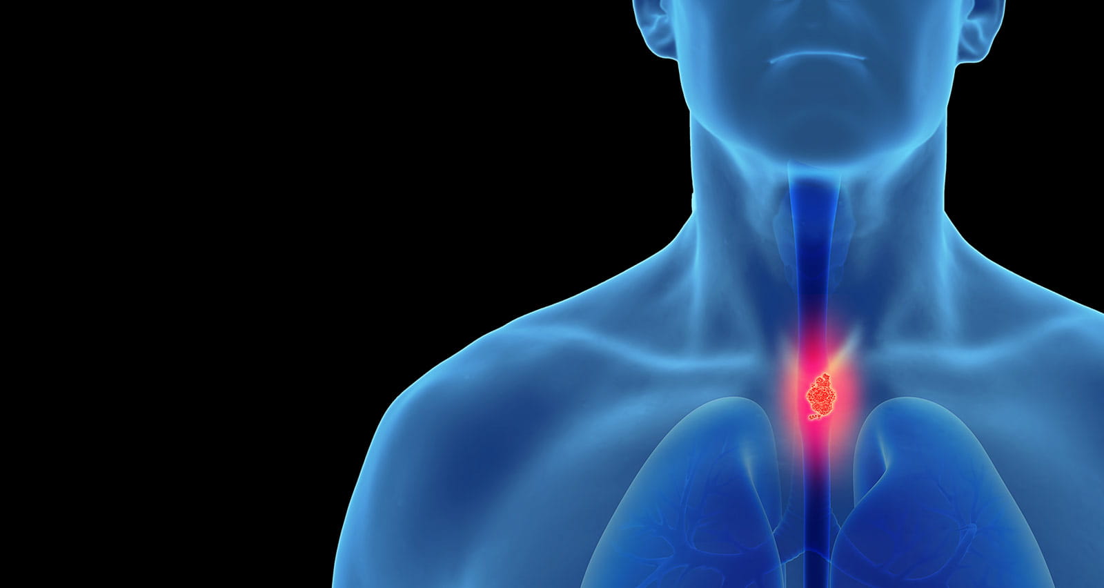 Illustration of esophageal cancer in the human male