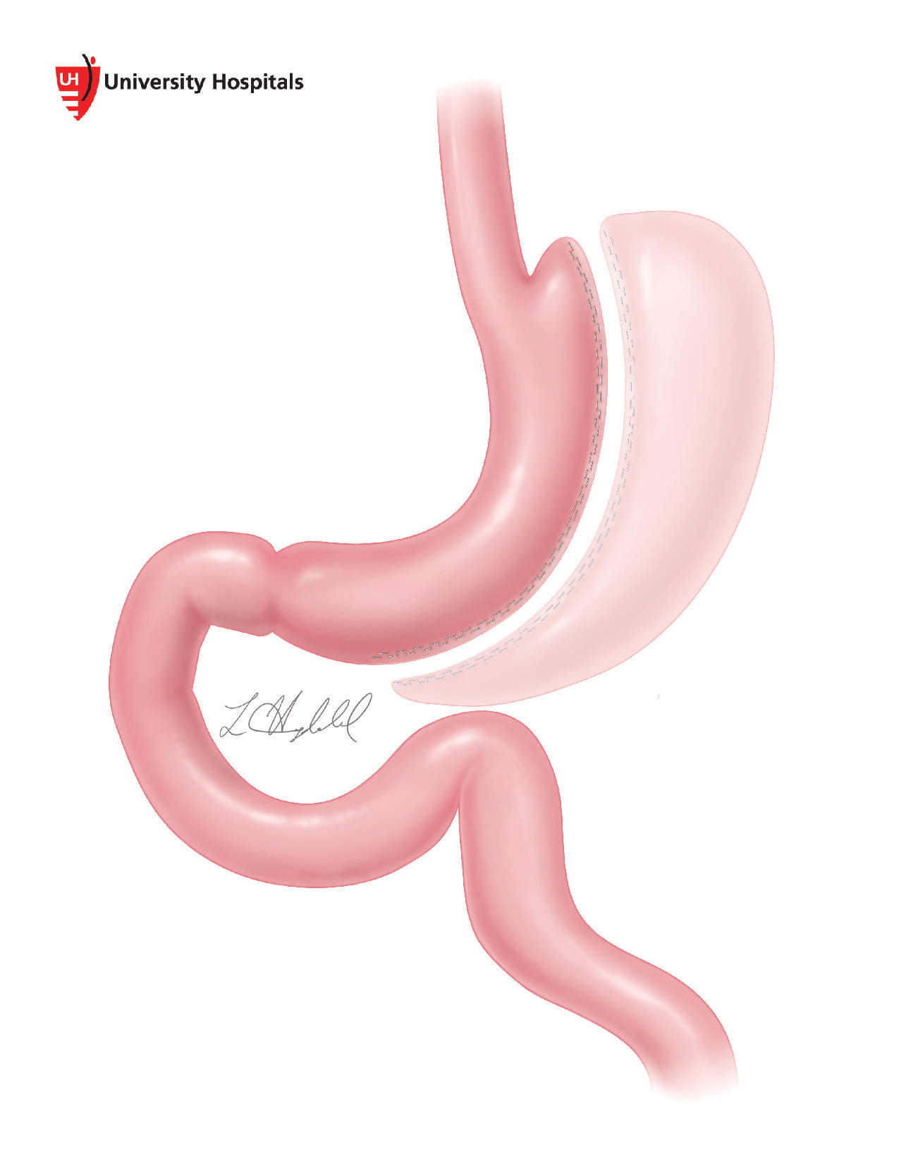 Illustration of gastric sleeve by L. Hugdahl