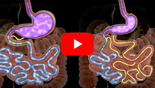 Illustration of before and after the duodenal switch procedure
