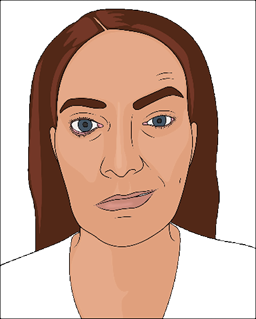 Sketch of facial paralysis