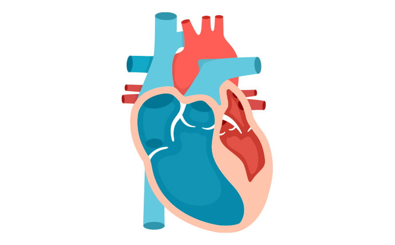 Illustration of Nonobstructive HCM (NHCM)