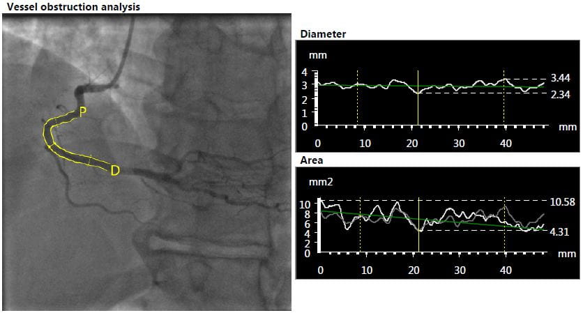 heart imaging lab qca 1-1