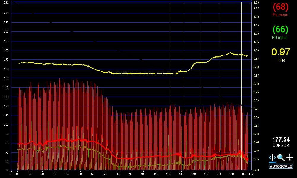 Fractional Flow Reserve FFR