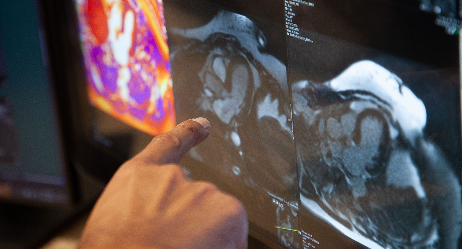 Onscreen analysis at UH Harrington Heart & Vascular Institute