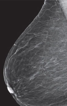 Breast Density Almost Entirely Fatty