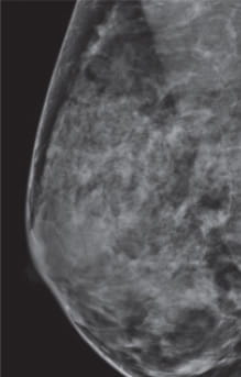 Breast Density Extremely Dense