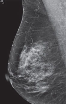 Breast Density Heterogeneously Dense