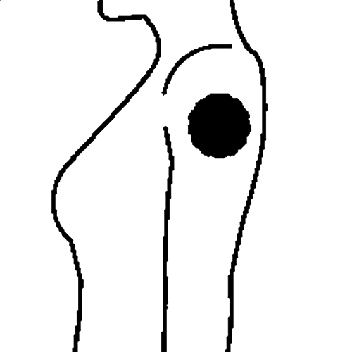 Illustration of an injection site on your arm