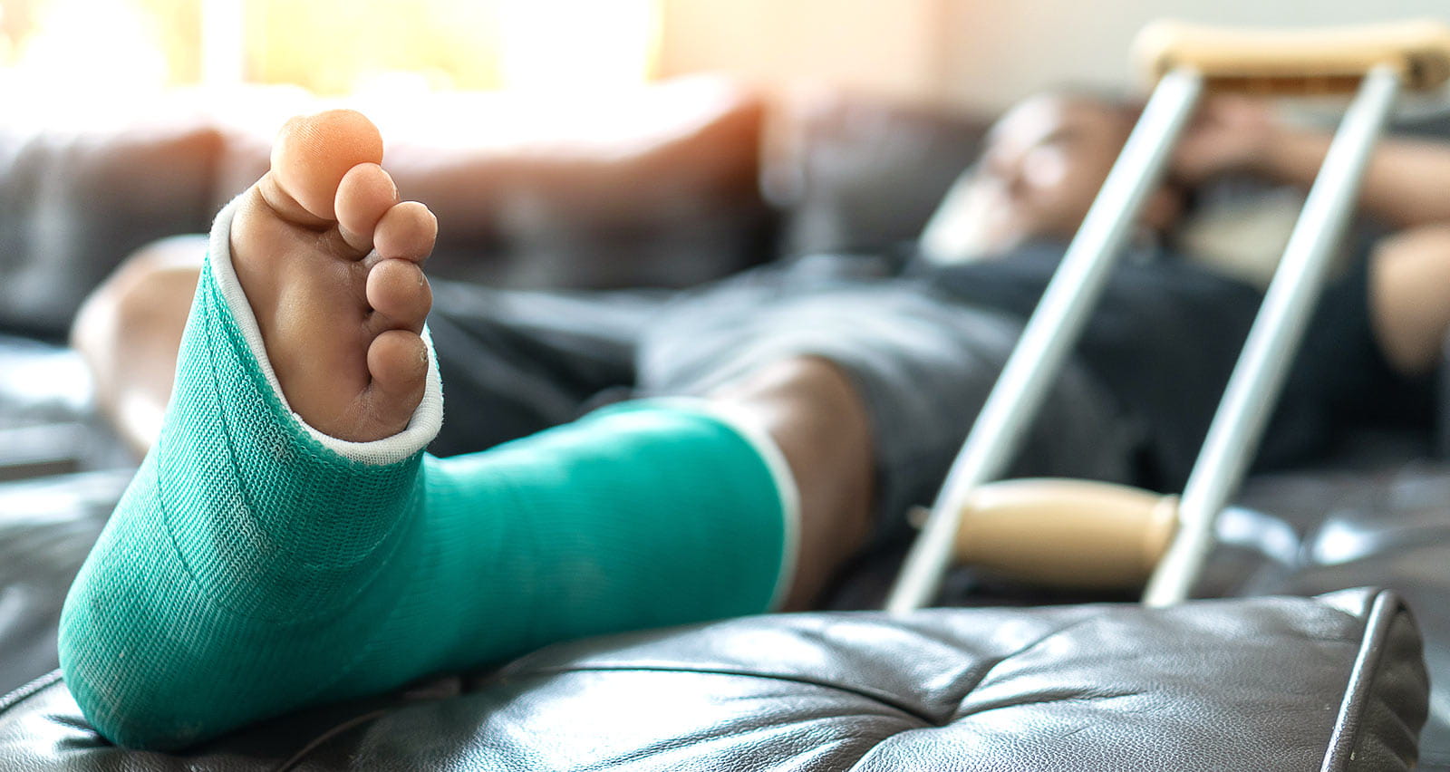 A male patient with a splint cast and crutches recovers from a foot fracture