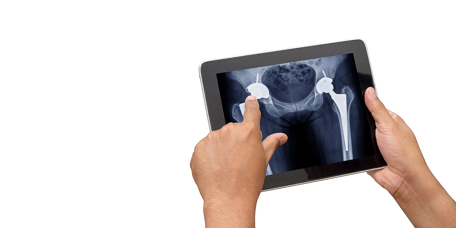 Doctor checking x ray of patient who have both side total hip replacement in tablet