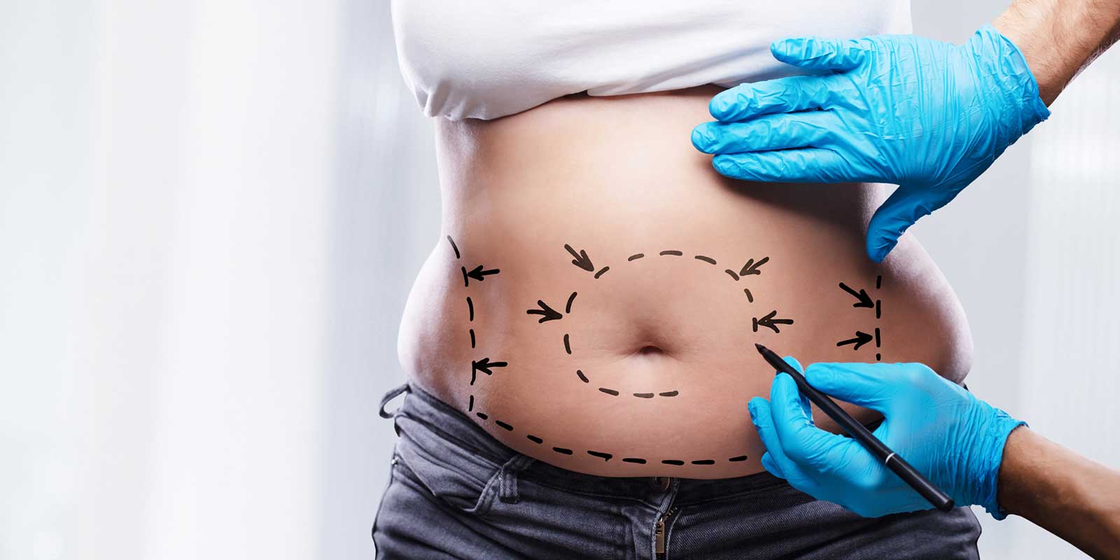 Plastic Surgeon Drawing On Woman's Body For Surgery