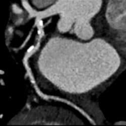 Sample Coronary Computed Tomography Angiography results