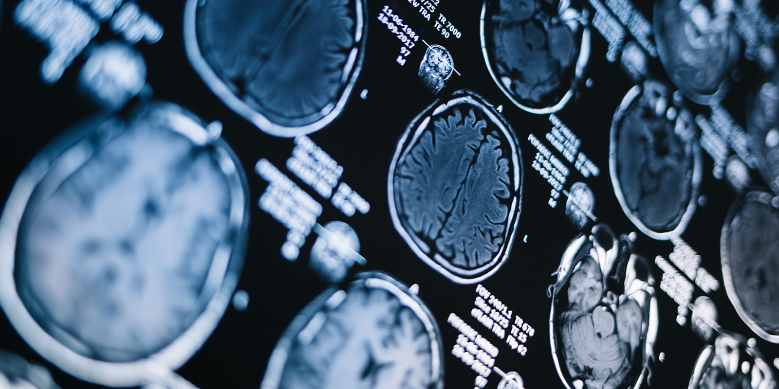 MRI brain scan.