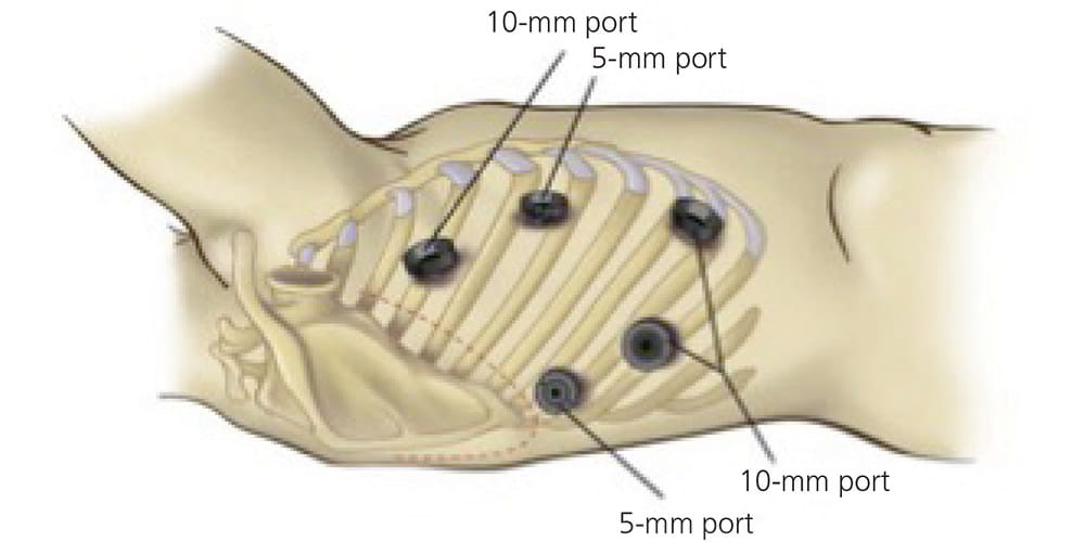 Illustration demonstrating the incisions made in Minimally Invasive Esophagectomy