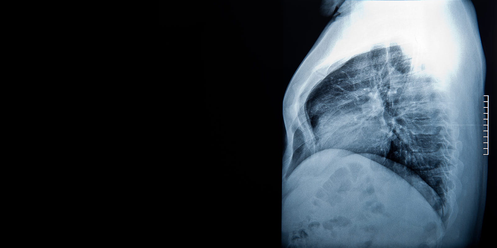 A lateral projection x-rays of lungs and heart shadow, the chest shows a deformity called "pectus excavatum"