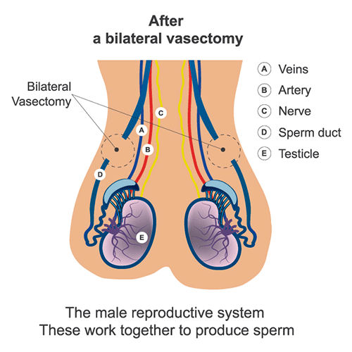 Vasectomy Diagram